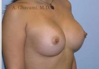 Procedure before and after - after