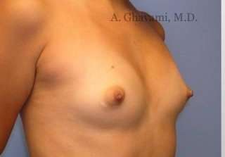 Procedure before and after - before