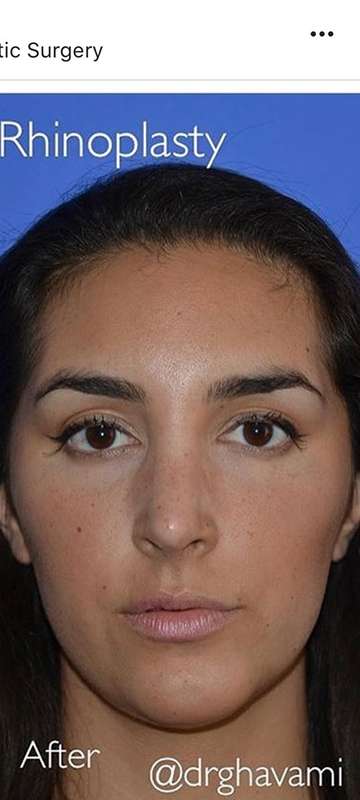 Rhinoplasty before and after - after