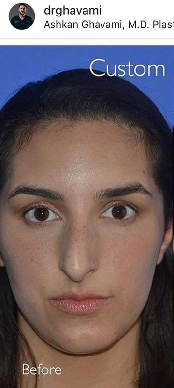 Rhinoplasty before and after - before