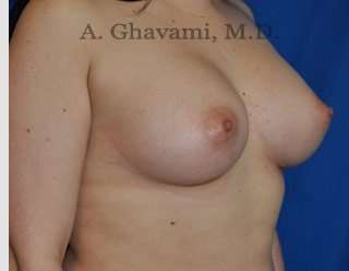 Procedure before and after - after