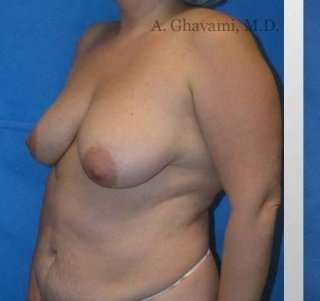 Mommy Makeover before and after - before