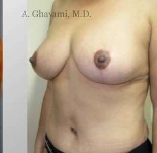 Procedure before and after - after