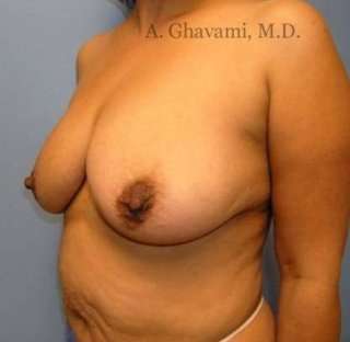 Procedure before and after - before