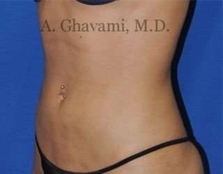 Liposuction before and after - after