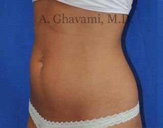 Liposuction before and after - before