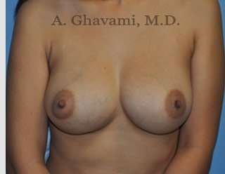 Procedure before and after - after