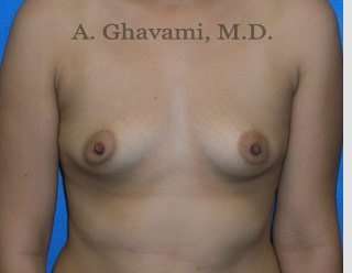 Procedure before and after - before