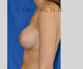 Procedure before and after - after