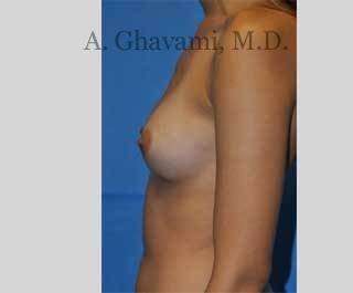 Procedure before and after - before