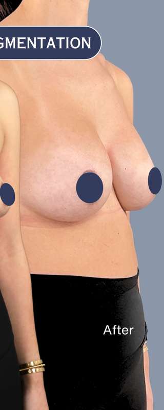 Procedure before and after - after