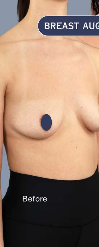 Procedure before and after - before