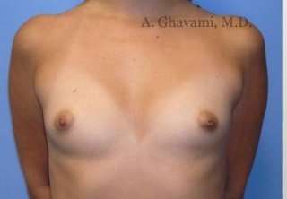 Procedure before and after - before