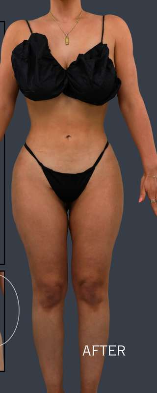 Liposuction before and after - after
