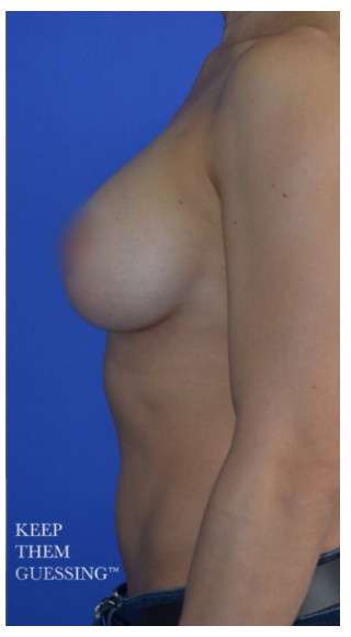 Procedure before and after - after