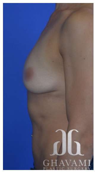 Procedure before and after - before