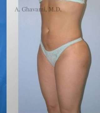 Liposuction before and after - after