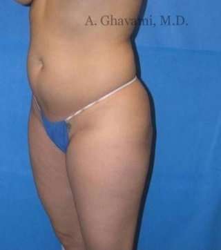 Liposuction before and after - before