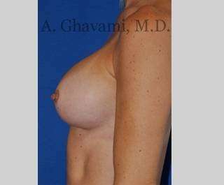 Procedure before and after - after