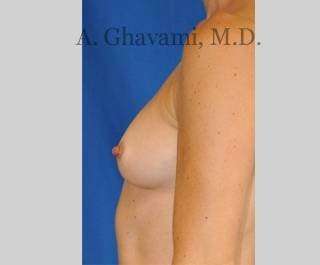 Procedure before and after - before