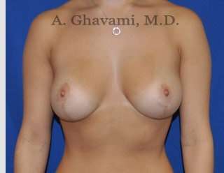 Procedure before and after - after