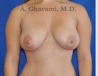 Procedure before and after - before