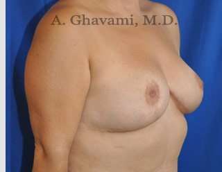 Procedure before and after - after