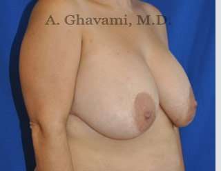 Procedure before and after - before