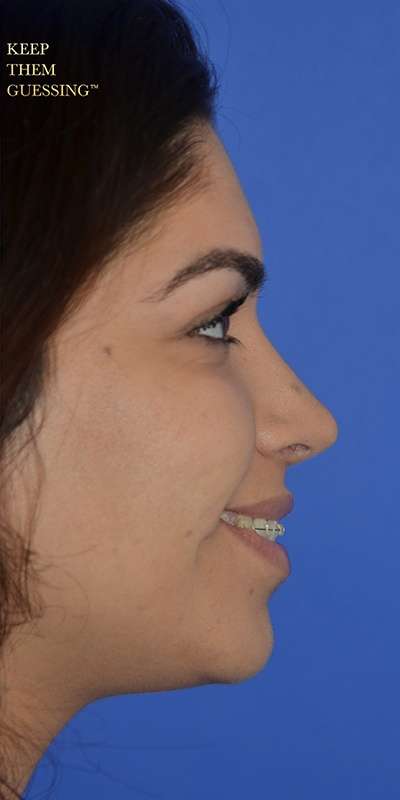 Rhinoplasty before and after - after
