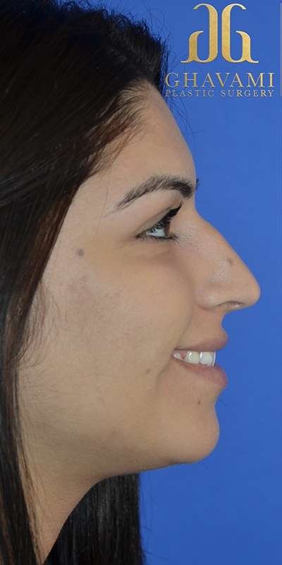 Rhinoplasty before and after - before