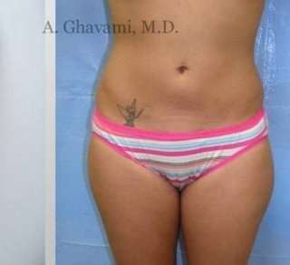 Liposuction before and after - after