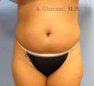 Liposuction before and after - before