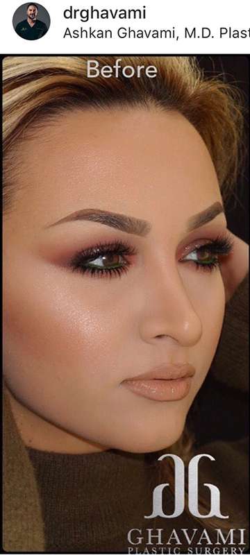 Rhinoplasty before and after - before