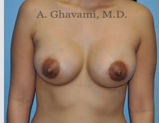 Procedure before and after - after