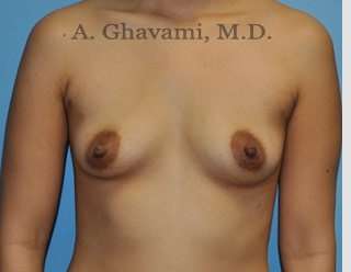 Procedure before and after - before