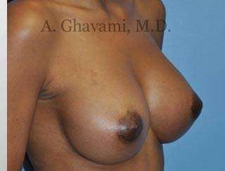 Procedure before and after - after