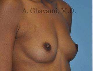 Procedure before and after - before