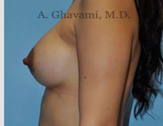Procedure before and after - after