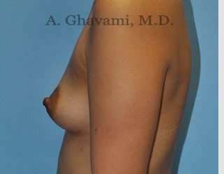 Procedure before and after - before