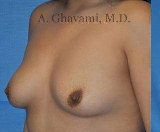 Procedure before and after - before