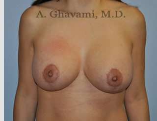 Procedure before and after - after