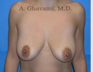 Procedure before and after - before