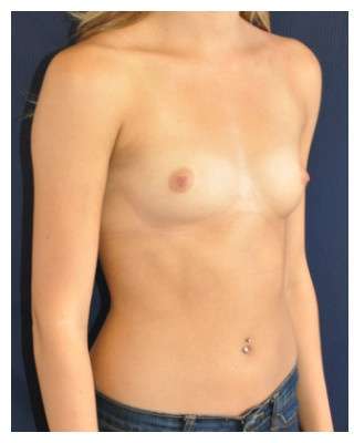 Procedure before and after - before