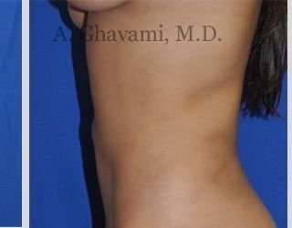 Liposuction before and after - after