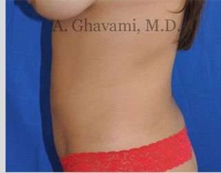 Liposuction before and after - before