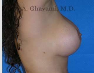 Procedure before and after - after