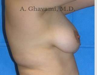 Procedure before and after - before
