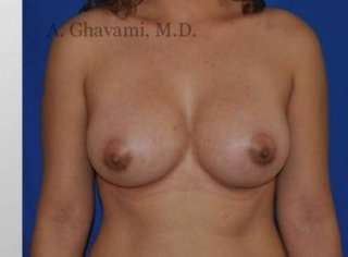 Procedure before and after - after