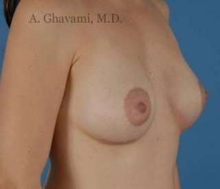 Procedure before and after - after