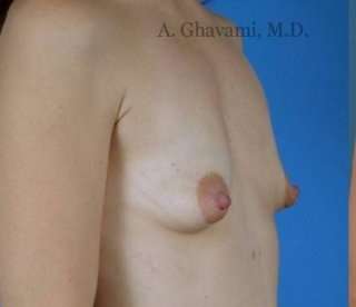 Procedure before and after - before